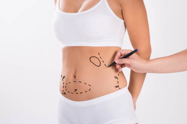 What Lifestyle Changes Enhance Liposuction Effectiveness